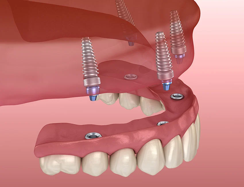 When Are All-on-4 Dental Implants the Best Option?