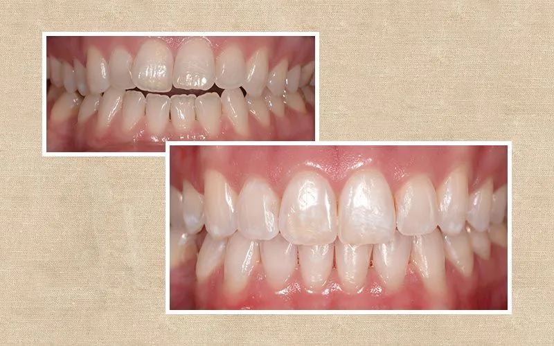 Invisalign before and after at Valencia Aesthetic Dentistry