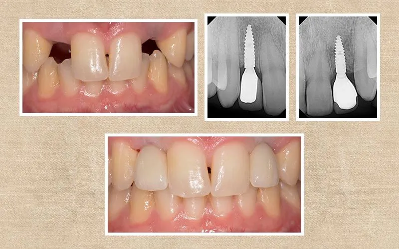 Implants before and after at Valencia Aesthetic Dentistry