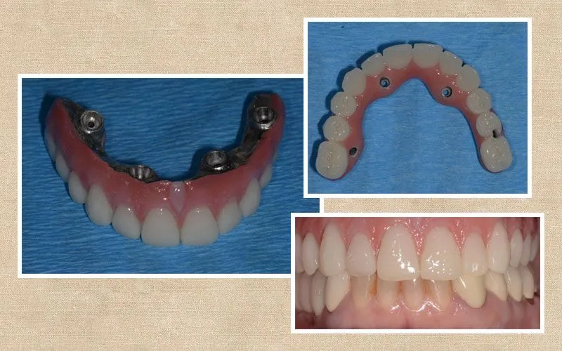 All-on-Four before and after at Valencia Aesthetic Dentistry