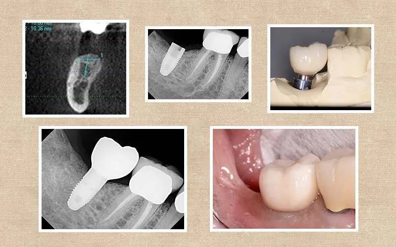 CT-Guided Implant before and after at Valencia Aesthetic Dentistry