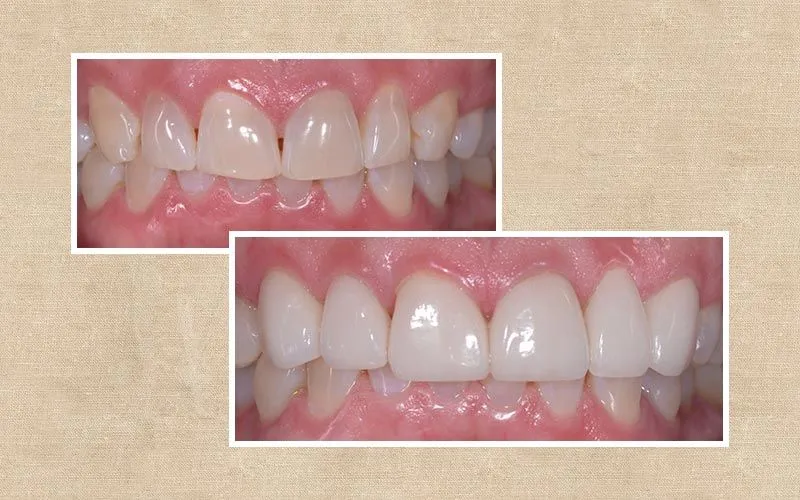 Veneers before and after at Valencia Aesthetic Dentistry