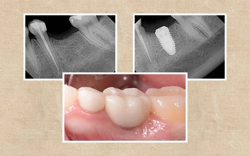 Single Tooth Implant before and after at Valencia Aesthetic Dentistry