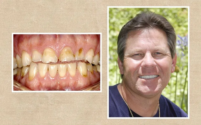 Complex Reconstruction before and after at Valencia Aesthetic Dentistry