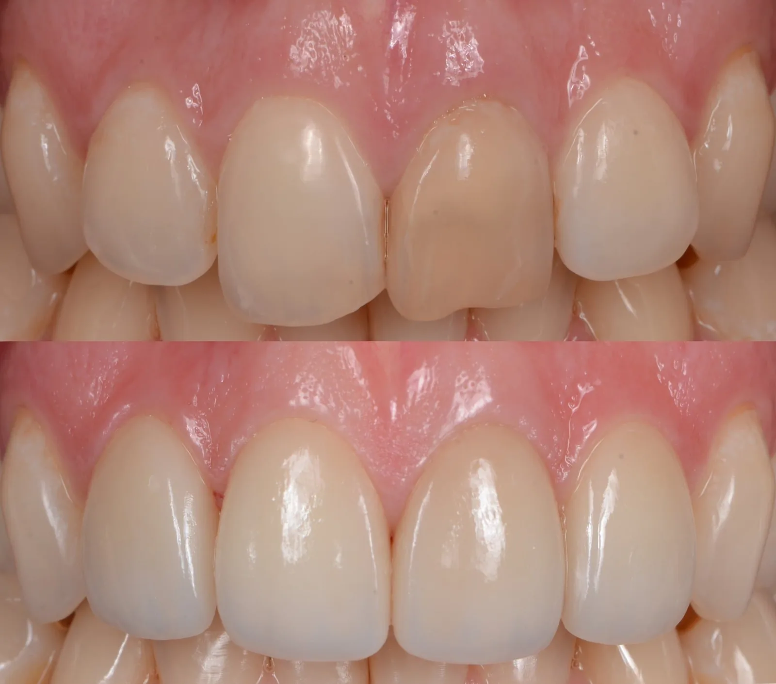 How Do I Fix a Chipped Front Tooth?