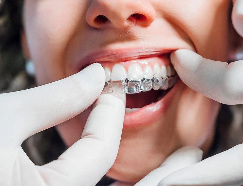 What is Retainers