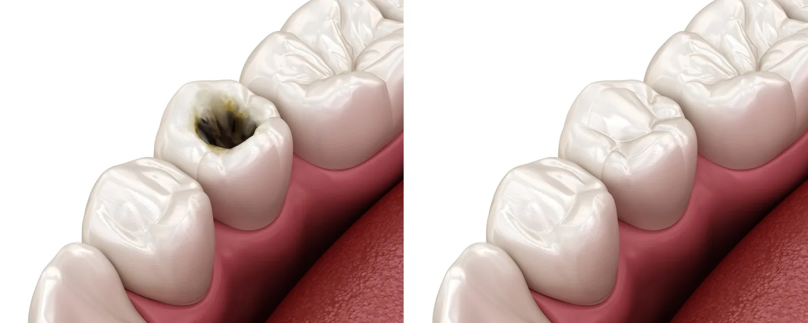 How Long Do Tooth-Colored Fillings Last?