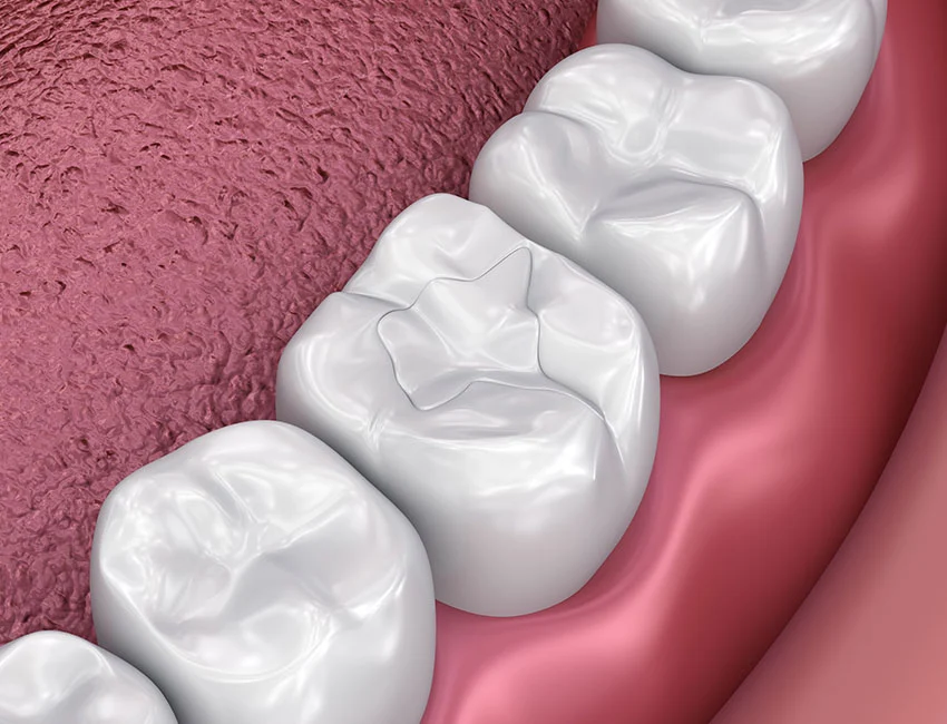 Why Did My Dental Filling Turn Black?