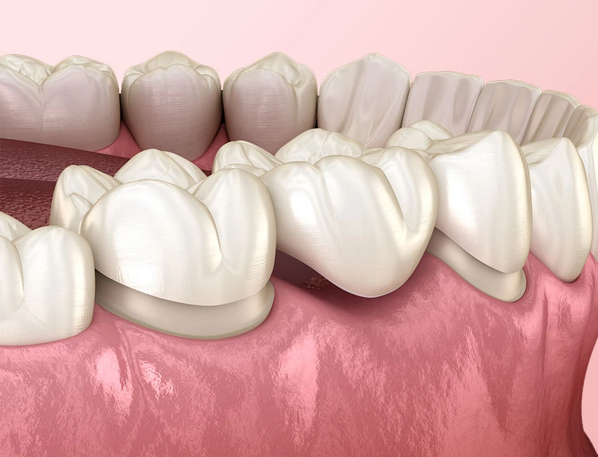 What is Dental Bridge