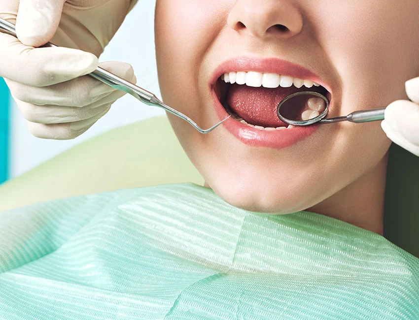 What is Dental Sealants