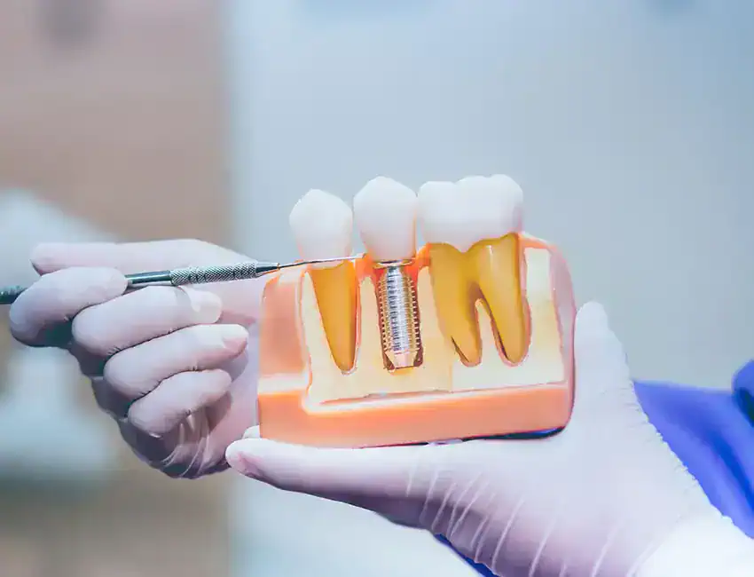 What Do I Need To Know Before Getting Dental Implants?
