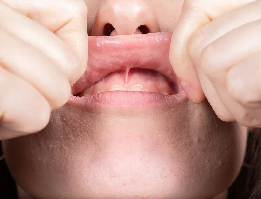 What is Frenectomy