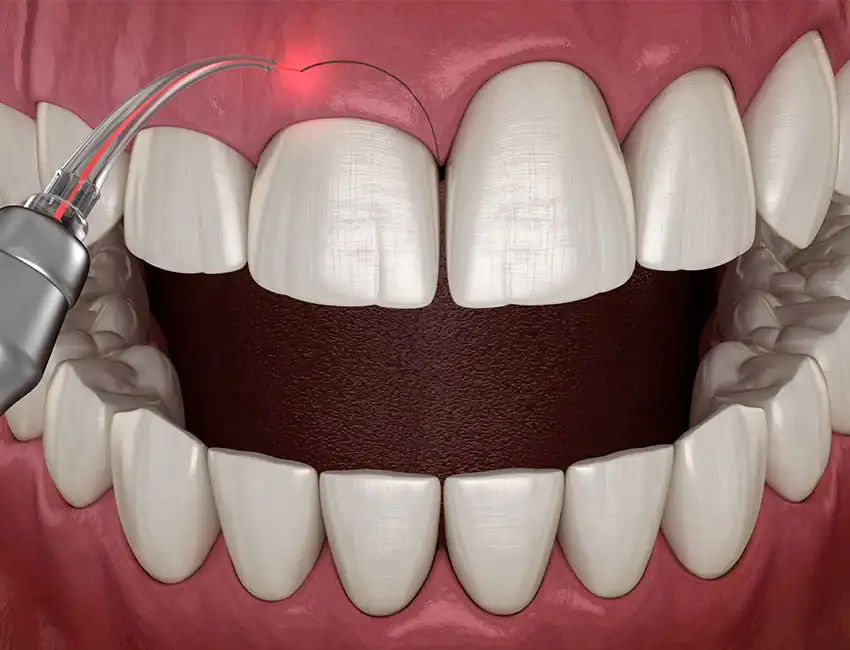 Our Comprehensive Guide to Gummy Smile Treatment