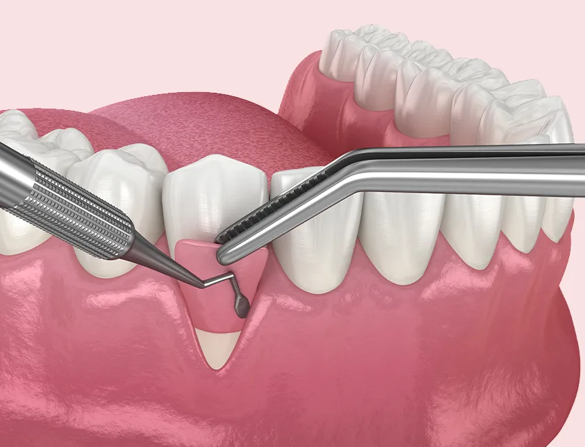What is Gingival Grafting
