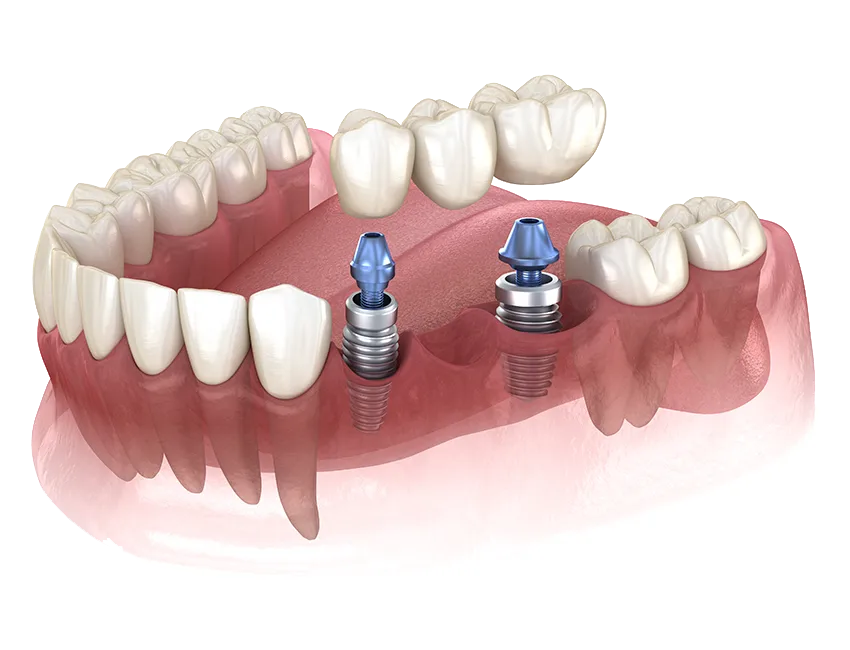 Multiple-Tooth Implant-Supported Bridge
