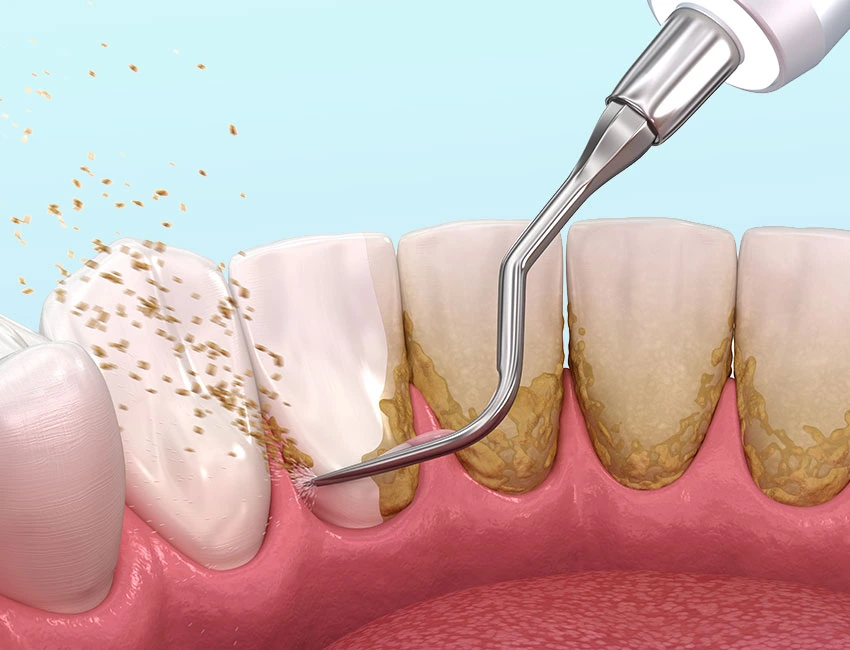What is Periodontal Care