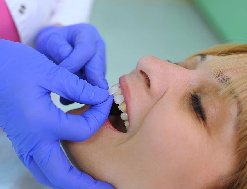What is Veneers