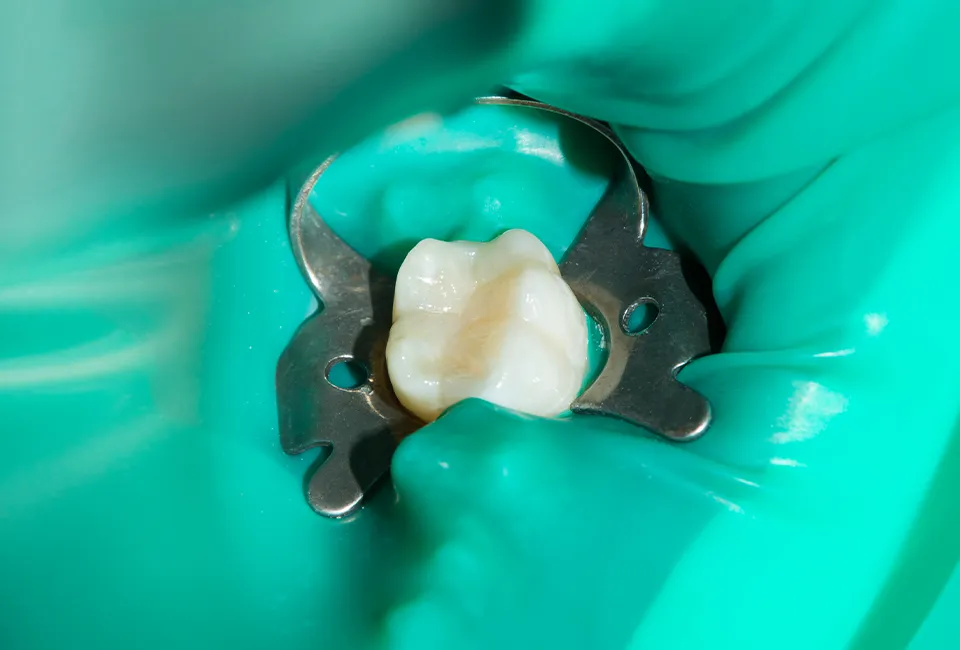 Am I a Candidate for Root Canal Treatment?