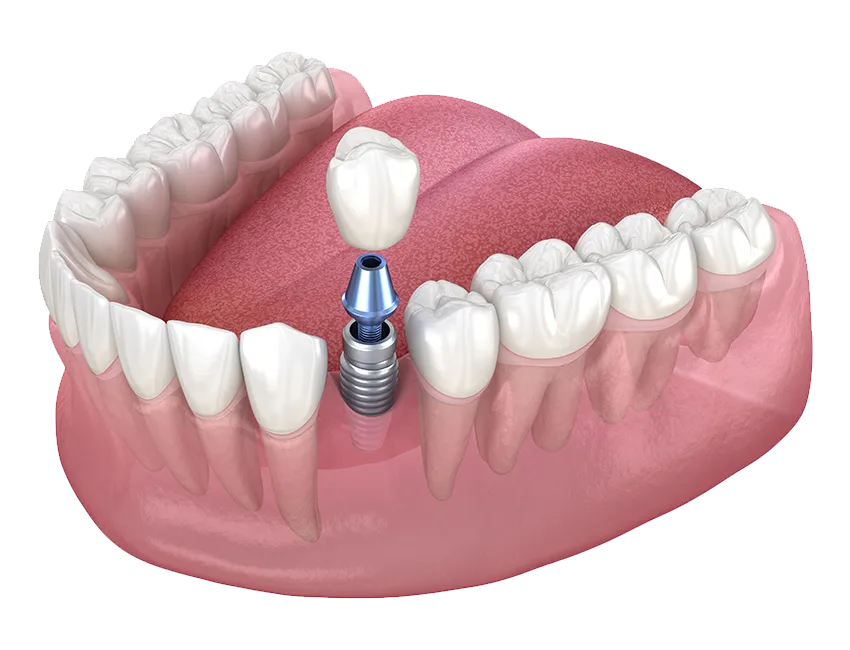 Single Tooth Implant