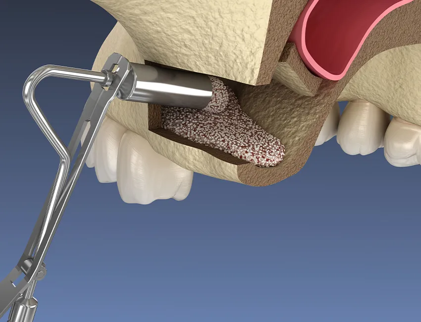 What is Sinus Lifts