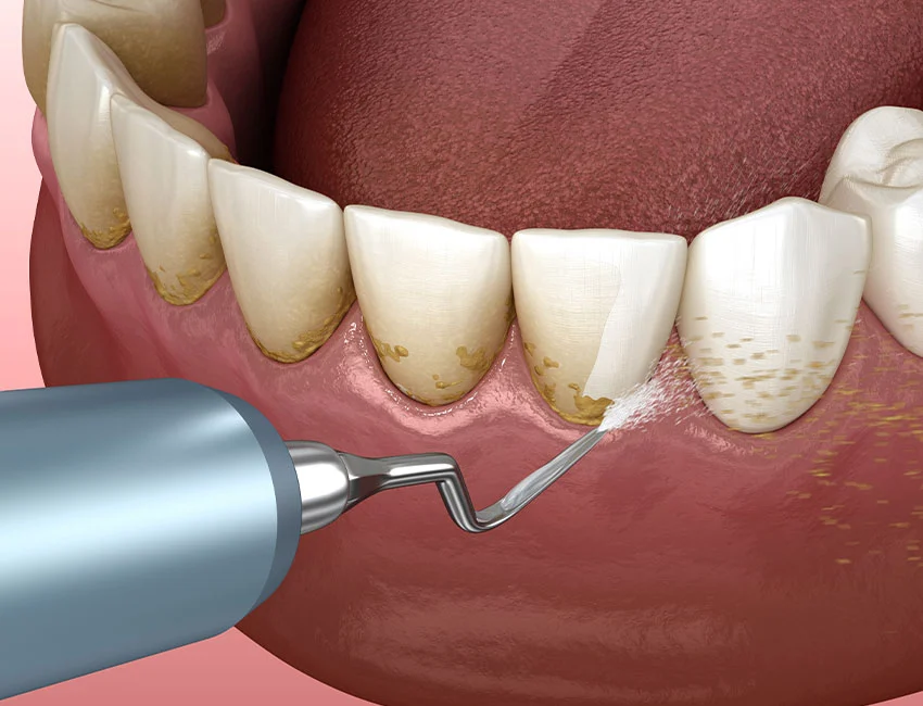 What is Teeth Cleaning & Fluoride Treatment