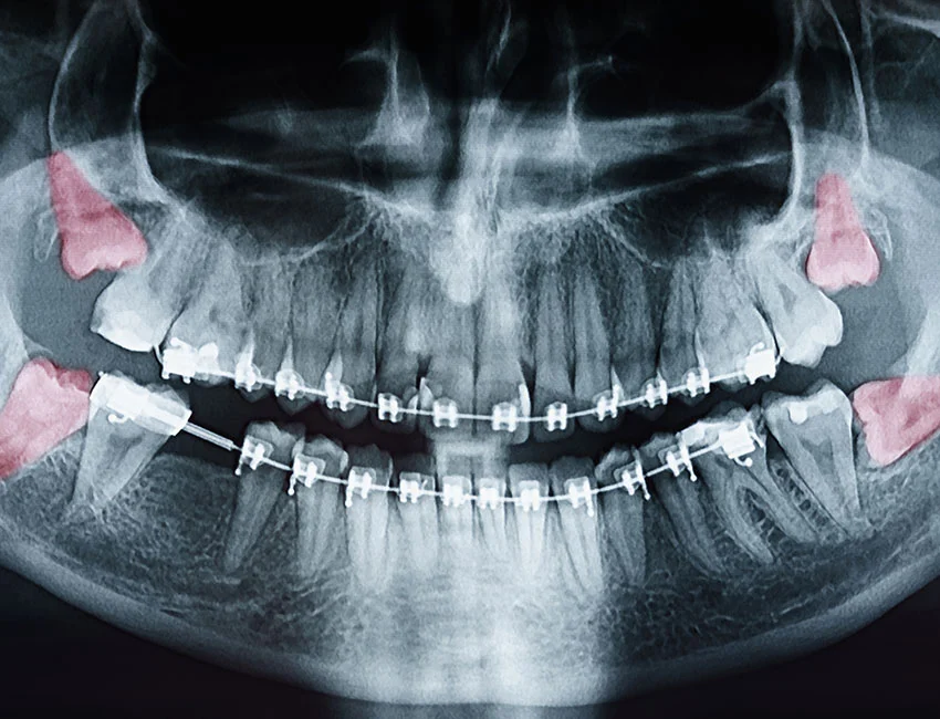 Do I Really Need My Wisdom Teeth Removed?